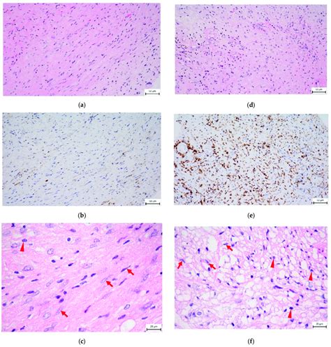 Histology of VS, sections from the same tumor. Arrows show tumor cell... | Download Scientific ...