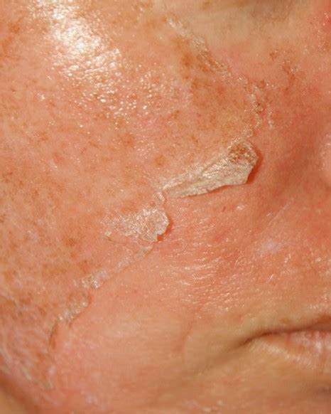 👉 Flaky Skin - Symptoms, Treatment, Causes, Pictures (February 2022)