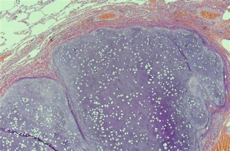 Microscopic appearance of the lung hamartoma. | Download Scientific Diagram