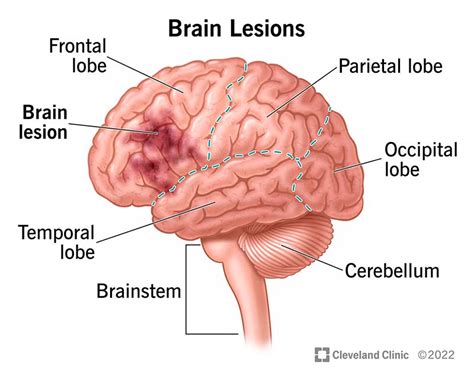 Left Parietal Occipital Lobe