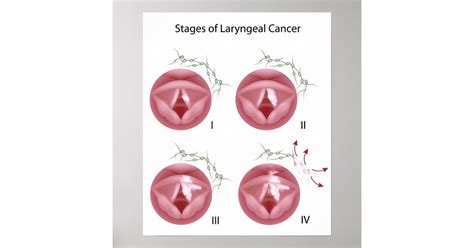 Laryngeal cancer stages Poster | Zazzle