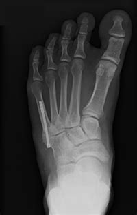 5th Metatarsal Fracture Surgery Procedure & Recovery