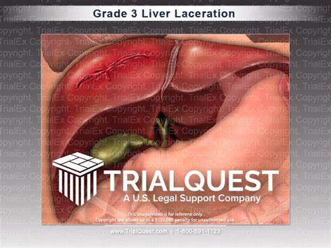 Grade 3 Liver Laceration - TrialExhibits Inc.