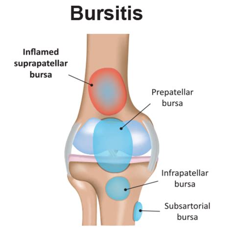 Bursitis Knee Pain - Carolinas Pain Center - Pain Relief Options