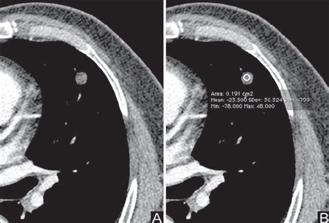 Fat. Presence of intranodular fat in hamartoma. Chest CT – mediastinal... | Download Scientific ...