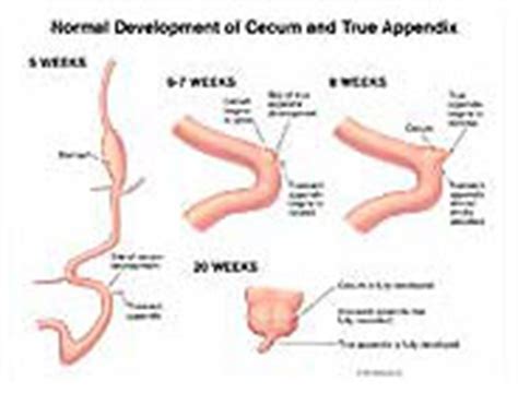 Normal Development of Cecum and True Appendix Medical Exibit