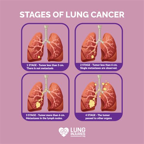 Stage 2 Of Lung Cancer