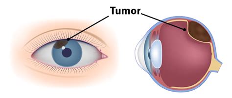 Cancer in the EYE: Unexpected Thought - Discovery Eye Foundation