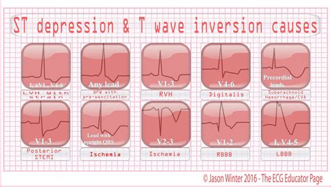 ECG Educator Blog : ST depression & T wave inversion causes