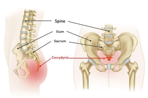 Coccydynia: Symptoms, Causes, Treatment By Back Braces