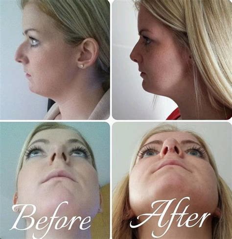 Deviated Septum Before And After (5) » Rhinoplasty: Cost, Pics, Reviews ...