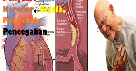 Penyakit Jantung Koroner, Gejala, Penyebab, Pencegahan - Bagikan Manfaat 7