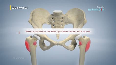 Severe Symptoms Of Hip Bursitis