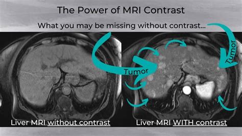 Can I Refuse Contrast Dye for MRI Scans?