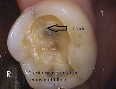 How to Fix a Cracked Tooth