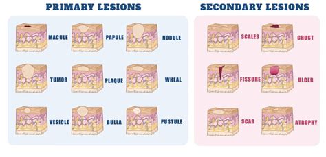 Types Of Skin Lesions: Diagnosis, Causes, Symptoms, And Treatment