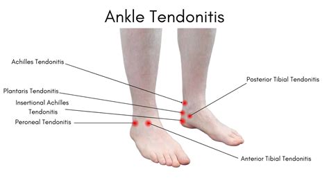 Ankle Tendonitis: Learn what causes Ankle Tendonitis