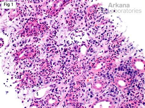 Acute Pyelonephritis in Transplants | Teaching Points | Arkana Labs