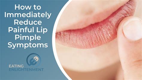 How to Immediately Reduce Painful Lip Pimple Symptoms — Eating ...