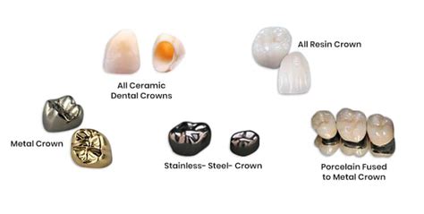 Types Of Dental Crown Materials - Design Talk