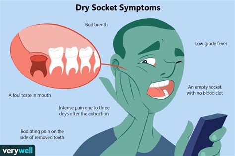 Dry Socket: Causes, Symptoms, Diagnosis, Treatment