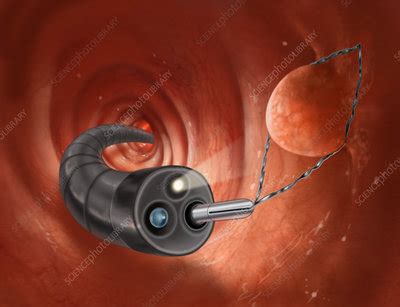 Polyp Removal during Colonoscopy - Stock Image - C022/1032 - Science Photo Library