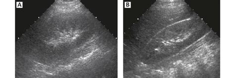 Diffuse acute pyelonephritis in a 31-year-old woman. (A) Longitudinal... | Download Scientific ...