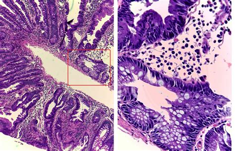 GASTROINTESTINAL AND LIVER HISTOLOGY PATHOLOGY ATLAS: SESSILE SERRATED POLYP (AKA SESSILE ...