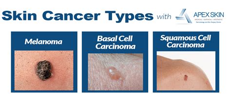 Skin Cancer Types Pics