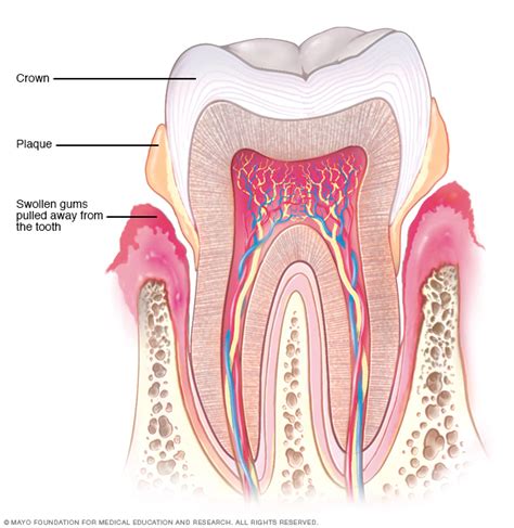 Periodontitis - Symptoms and causes - Mayo Clinic