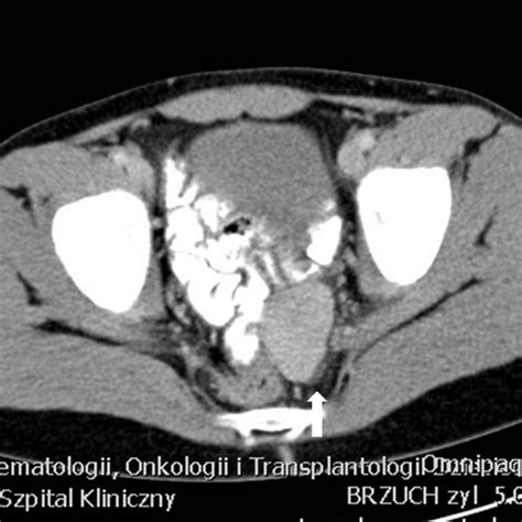 The ectopic spleen. CT scan of the pelvis with the spleen tissue on the... | Download Scientific ...