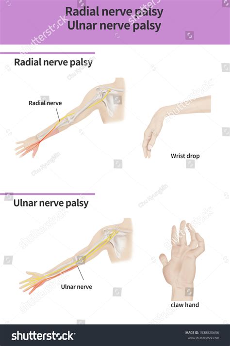 Radial Nerve Injury