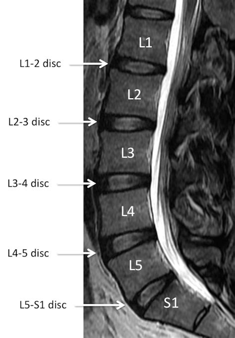 Mri Lumbar Spine Anatomy - Anatomy Reading Source