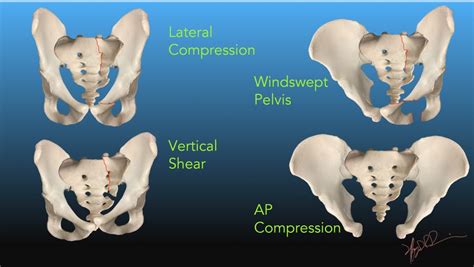 Pelvic Fracture X Ray