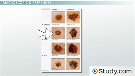 Benign Neoplasm Of Breast