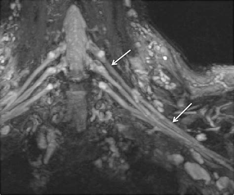 High-Resolution 3T MR Neurography of the Brachial Plexus and Its Branches, with Emphasis on 3D ...