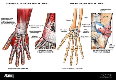 Ligament Injury