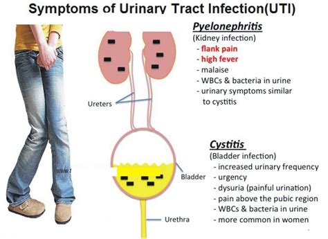 Urinary Tract Infection Causes Spasms at Thomas Ehmann blog