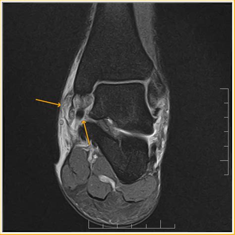 Deltoid Ligament Disruption : MRI - Sumer's Radiology Blog