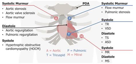 Aortic Stenosis Murmur