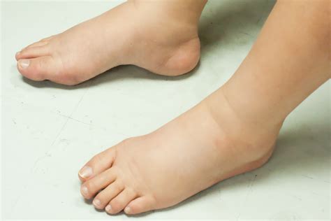 Why Do You Have Swollen Feet and Ankles? | Wellness | US News