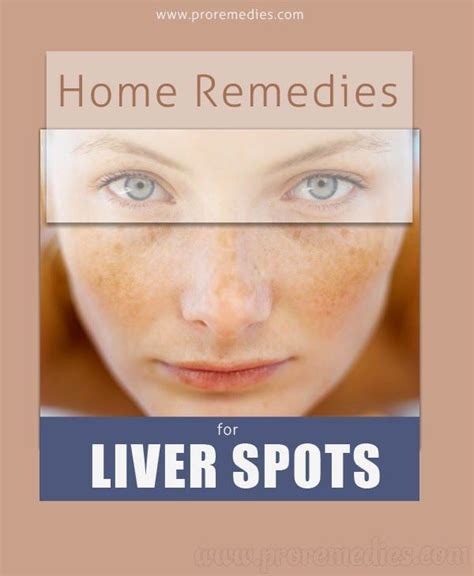 Home Remedies For Liver Spots | Home remedies, Remedies, Health and ...