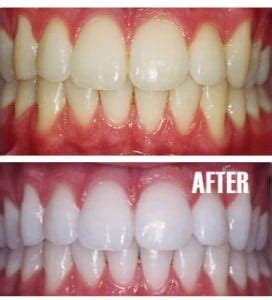 teeth-whitening-before-and-after-up-and-down - Winchester Dental