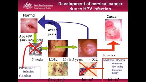 cervical cancer | Image Gallery