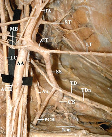 Subscapular Artery Cadaver