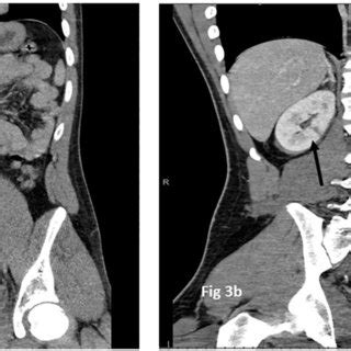 A grade 1 liver laceration (a) highlighted in the solid black circle... | Download Scientific ...