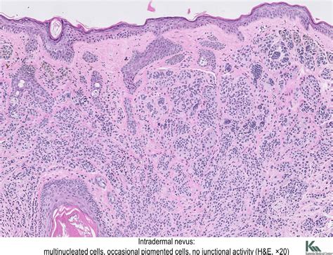 Melanocytic nevus