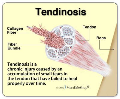 Achilles tendonosis