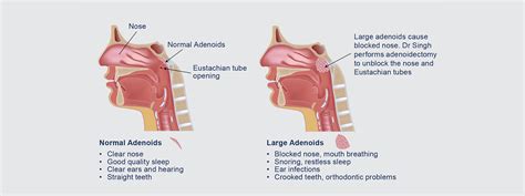 Adenoids Surgery