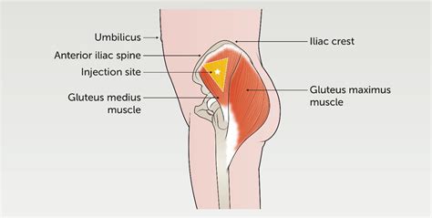 Three Intramuscular Injection Sites